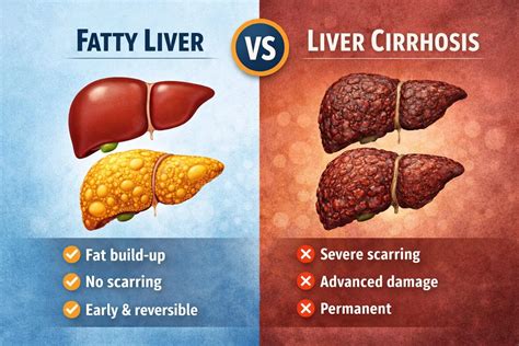 Fatty Liver Vs Liver Cirrhosis: Understanding The Key Differences And ...