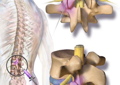 Image result for Right Side Nerve Root Block