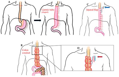 What Is A Esophageal Gastric Tube Airway at Hunter Wang blog