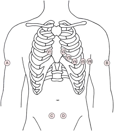 A new electrode placement method for obtaining 12-lead ECGs | Open Heart