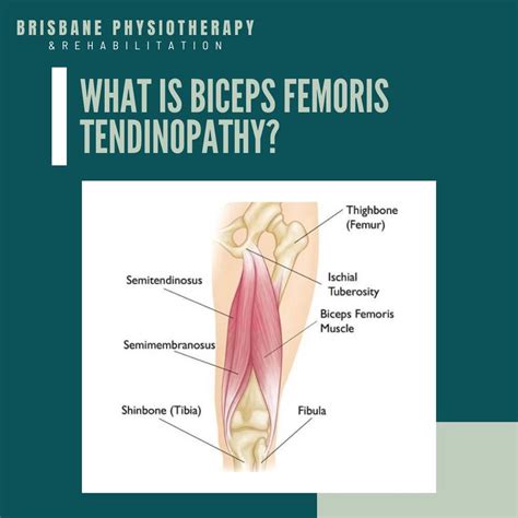 What is Biceps Femoris Tendinopathy? - Brisbane Physiotherapy