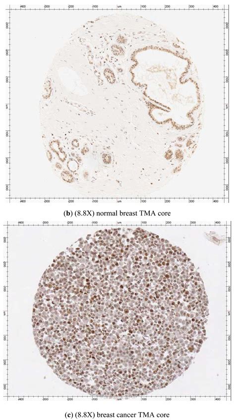 Immunohistochemical Assessment of Expression of Centromere Protein—A ...