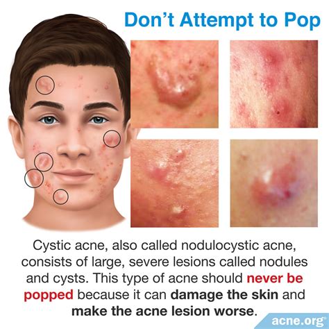 Nodulocystic Acne