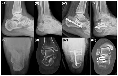 Surgical Treatment Using Sinus Tarsi Approach with Anterolateral ...