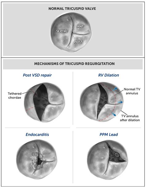 Tricuspid Valve