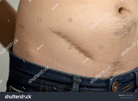 Image result for Appendix Surgery Scar
