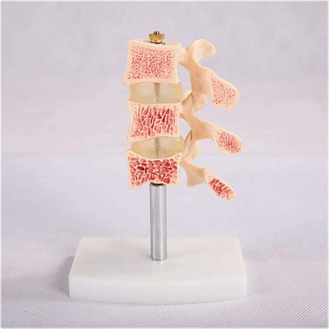 Education Model Human Osteoporosis Model Osteoporosis Joint Model Bone ...