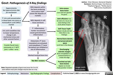 Gout: Pathogenesis of X-Ray findings | Calgary Guide