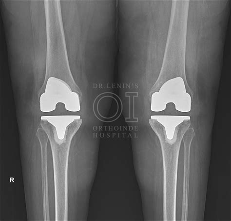 Dr. Lenin's Orthoinde Hospital | Best Orthopaedic hospital in Chennai