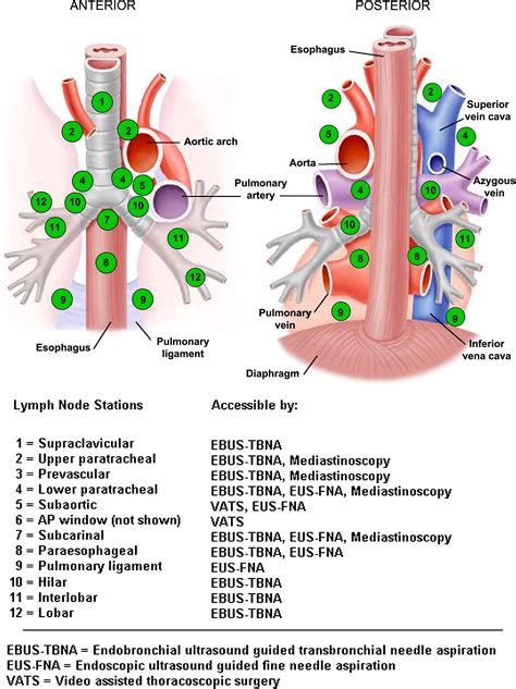 Thoracoscopic and Robotic Dissection of Mediastinal Lymph Nodes ...