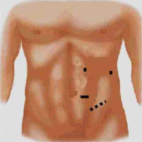 Image result for Nephrectomy Positioning