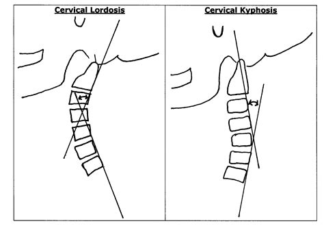 The Neck Curve The Importance of Cervical Lordosis