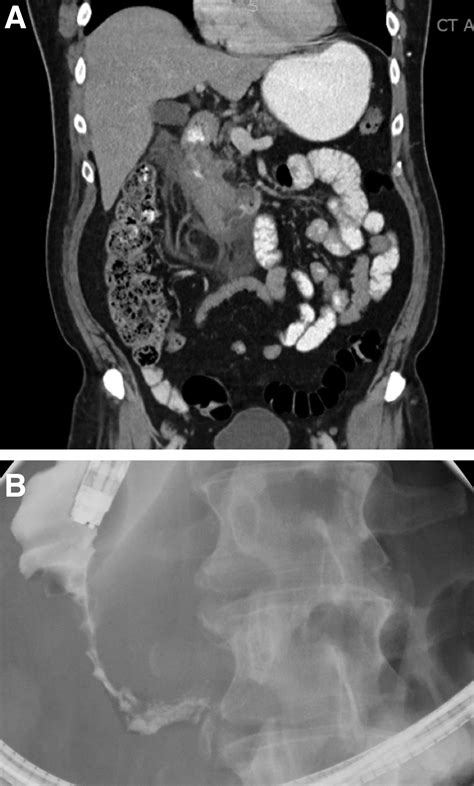 Incidental Apple-Core Lesion in the Duodenum: Ignore or Explore ...