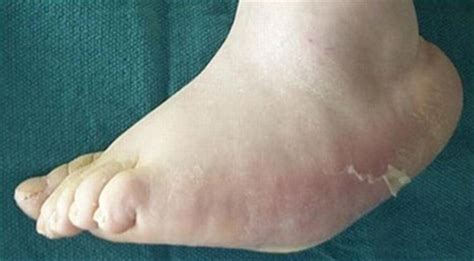 Diabetic Charcot Neuropathy - Foot & Ankle - Orthobullets