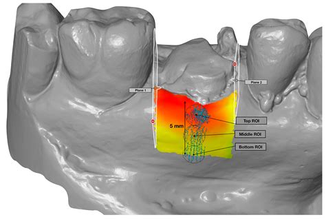 Contour Changes Following Immediate Placement of Ultra-Wide Implants in ...