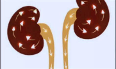 Microbiome Changes Linked to Kidney Stone Formation