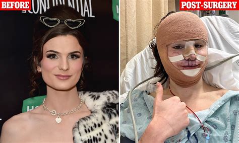 Transgender Surgery Before And After Photos