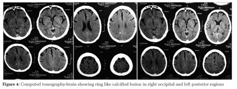 Disseminated Cysticercosis – Manifested with an Unusual Symptom