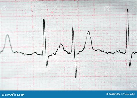 ECG ElectroCardioGraph Paper that Shows Normal Sinus Rhythm NSR with ...