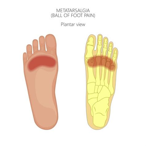 Top Of Foot Pain Diagram