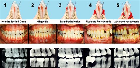 Preventive Care - Keeping Gum Diseases Away | Cornell Dental Centre