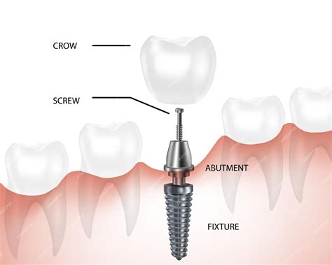 Premium Vector | Dental implant component parts tooth denture components vector