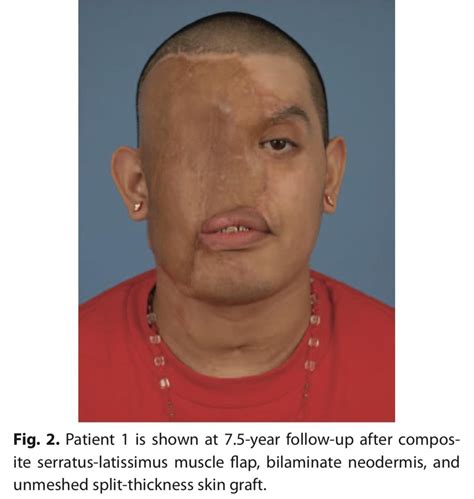 Horrific facial burns, reconstruction, and hope: a series of cases : r ...