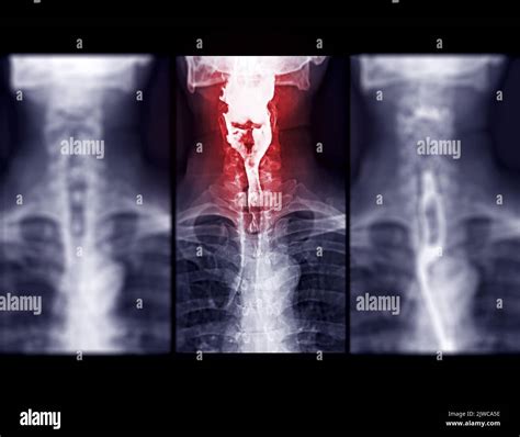 Barium Swallow study test diagnose Barrett's GI tract exam GERD ulcers ...