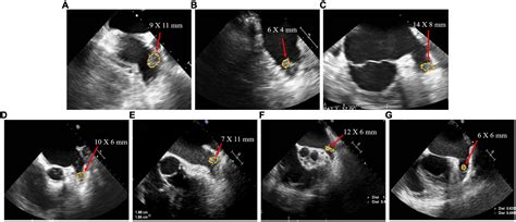 Frontiers | Percutaneous left atrial appendage closure using the LAmbre device in patients with ...