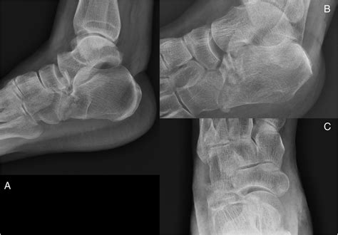 Anterior subtalar dislocation with comminuted fracture of the anterior ...