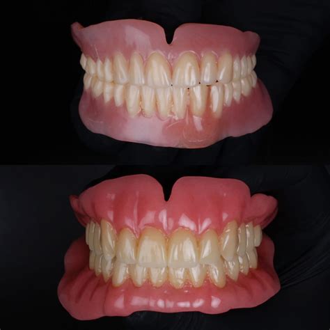 Finding The Best Type Of Dentures For Your Smile In 2026