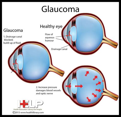 Primary Open Angle Glaucoma Signs at Isaac Dotts blog
