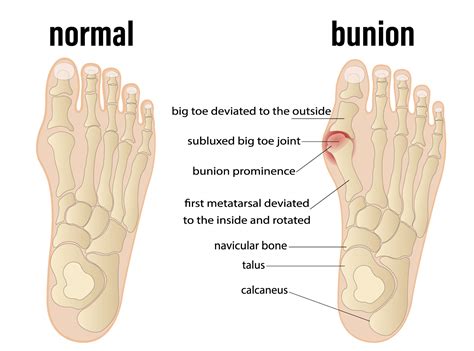 Why Does My Foot Hurt When I Walk - My FootDr Singapore