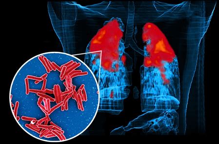 IIT Bombay Study Reveals How TB Bacteria Shield Themselves From ...