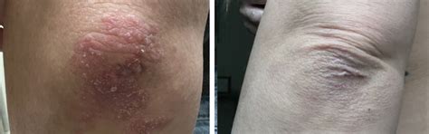 Small Patches - Eczema and Psoriasis Care Bundle – Oleum Cottage