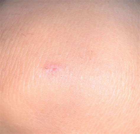 Anxious about Bat Bite : r/WildlifeRehab