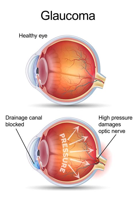 Merrillville, IN Selective Laser Trabeculoplasty - SLT for Glaucoma Treatment