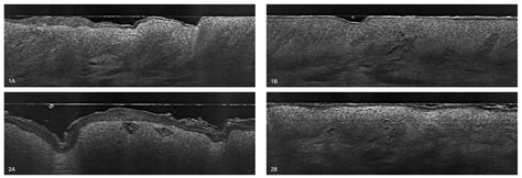 The Usefulness of Line-Field Confocal Optical Coherence Tomography in ...