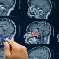 Brain Abscess/ Brain Injury Pathophysiology - HealthFinder