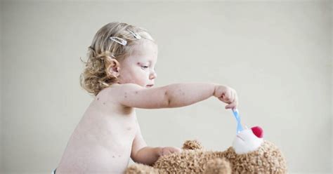 Childhood rashes: How to help identify them and tell if they're serious ...