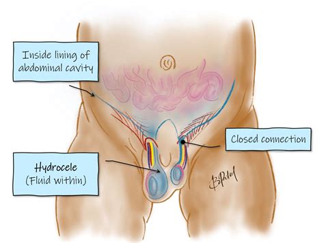 Hydrocele Surgery Before And After Frontiers | Laparoscopic Vs. Open