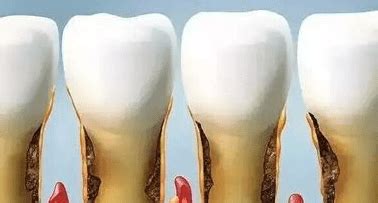 洗牙会导致牙缝变宽、牙齿松动吗？ - 知乎