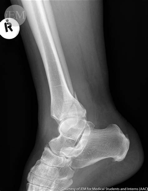 149.2 - ankle fx2 - fibula - lateral malleol fracture | Flickr