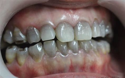 牙齒發黑是怎麼回事呢？