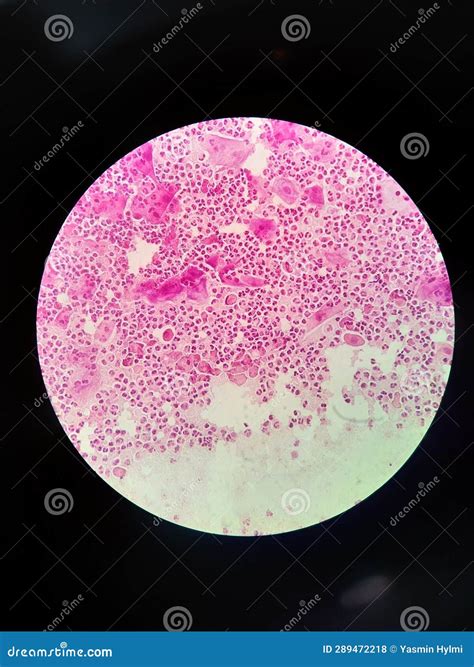 Trichomonas Vaginalis in Secret Vagina Specimen Stock Photo - Image of ...