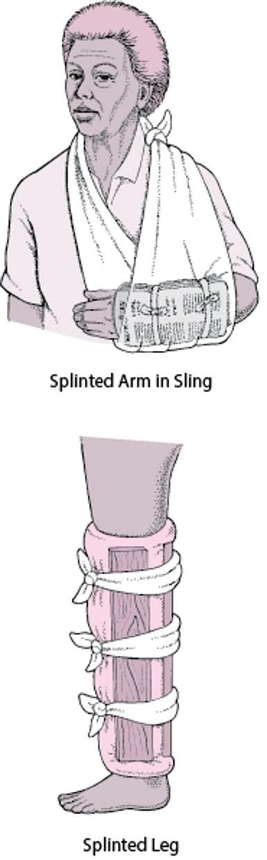 Image result for Types of Leg Splints