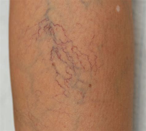 Spider Veins | Advanced Varicose Vein Treatments of Manhattan