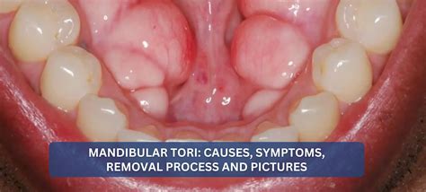 Mandibular Torus Info Prosthodontist Chevy Chase Mandibular Tori