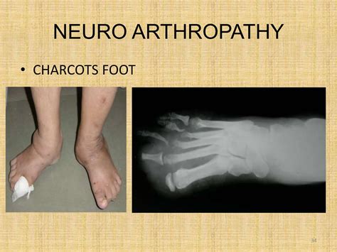 Diabetic Foot 1 - Intro, foot anat & Pathophysio.pptx
