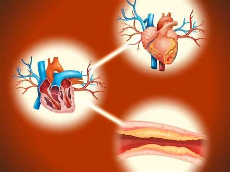 Calcium can accumulate your artery serious disease know warning sign ...